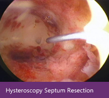 Hysteroscopy Septum Resection