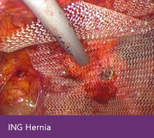 ING Hernia
